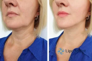 Double chin before and after Hi-Fu treatment 4 Book your double chin treatment Glasgow today! We are here to help!
