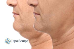Double chin before and after Hi-Fu treatment 2 Double chin treatment Glasgow from Lipo Sculpt - feel more confident today!