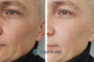 How to Fight Aging Symptoms 3 Fight Aging Symptoms Glasgow With HIFU and Morpheus8 Today!