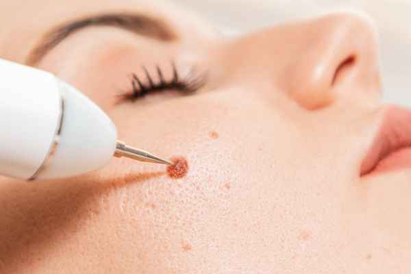 CryoPen: 5 Skin Concerns It May Be Used to Treat 3 What actually happens during a CryoPen treatment Glasgow?
