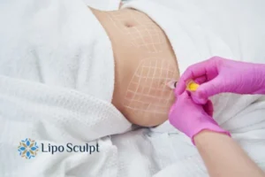 Are The Results From Aqualyx Permanent? 1 Do you want to know how long Aqualyx Glasgow results last?