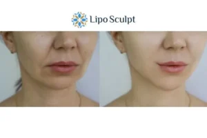 Explaining Total Skin Tightening Treatment And What It Can Do For You 2 Do you want to boost your self confidence? Give Morpheus8 Glasgow a try today!