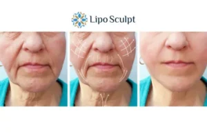 Explaining Total Skin Tightening Treatment And What It Can Do For You 3 Boost your confidence with Morpheus8 Glasgow call our team today!