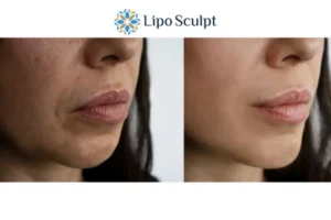 Explaining Total Skin Tightening Treatment And What It Can Do For You 4 Morpheus8 Glasgow the best results - call our team today!