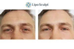 Explaining Total Skin Tightening Treatment And What It Can Do For You 6 Morpheus8 Glasgow book in today to find out more!