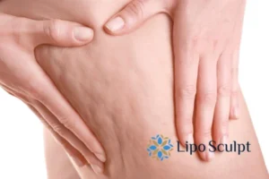 CoolSculpting for Legs: The Innovative Approach to Redefining Your Legs 5 Start your journey today book your coolsculpting treatment Glasgow online today!